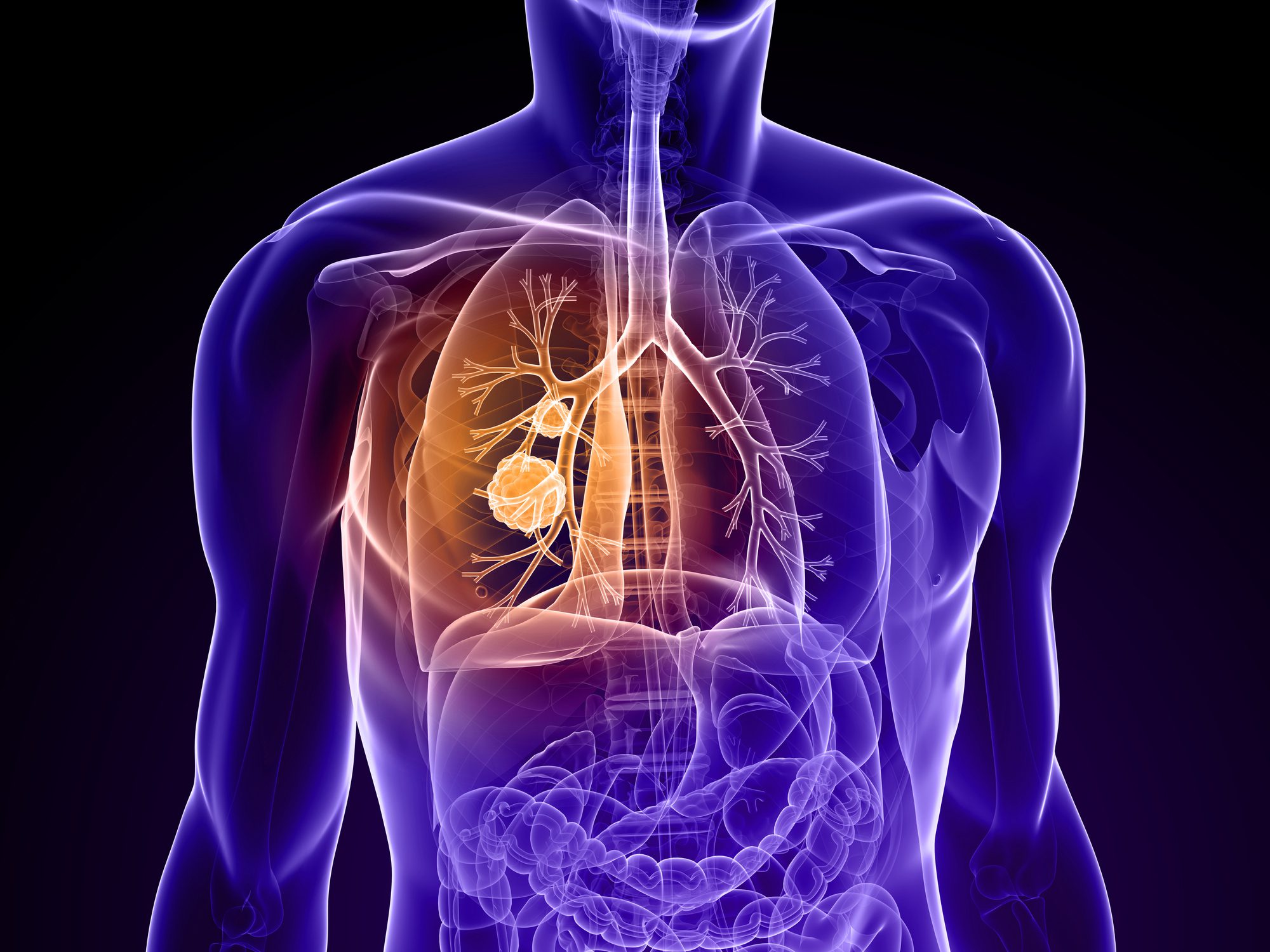 AI tool identifies high lung cancer risk in non-smokers using routine ...